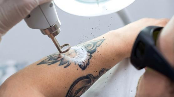 Enlever tatouage 