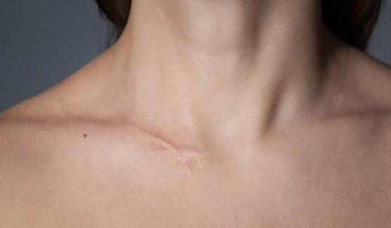 Cicatrice et imperfection 